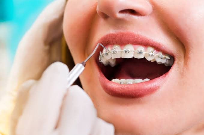 Braces