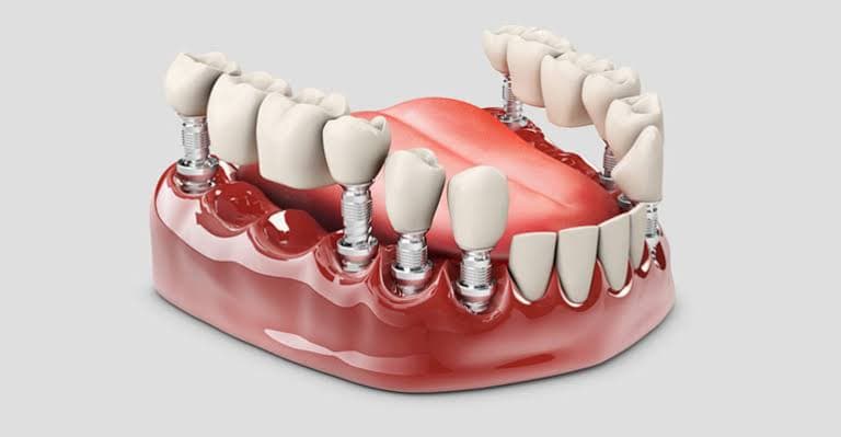 Dental Crowns & Bridges