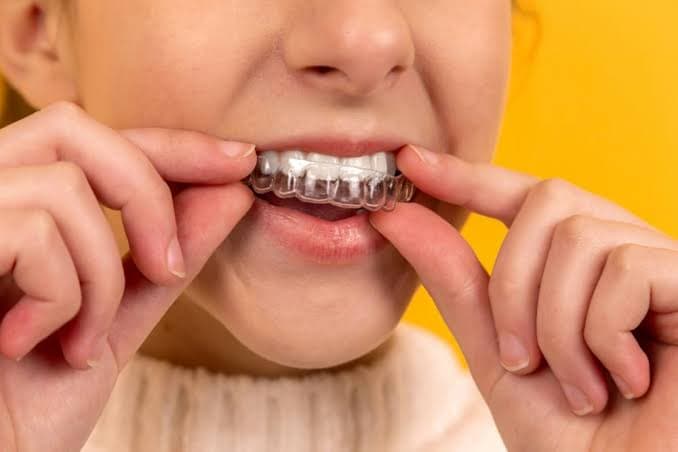 Invisalign & Clear Aligners