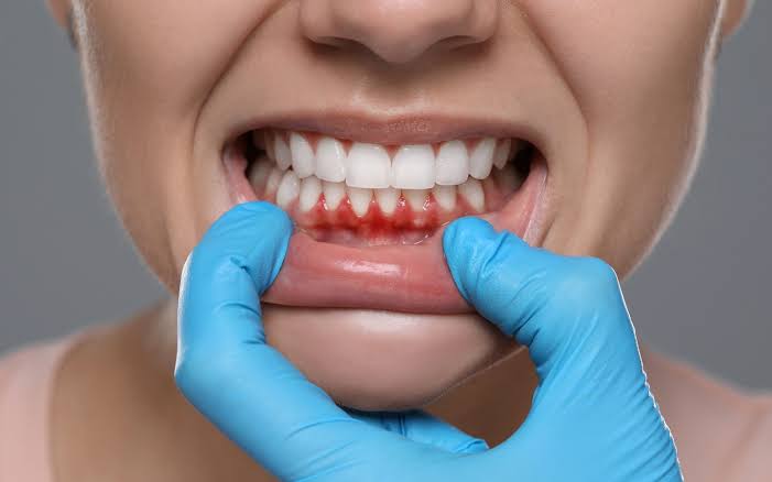 Periodontal (Gum) Treatment