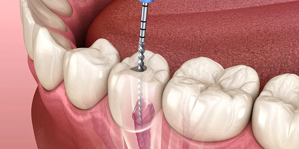 Root Canal