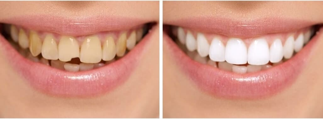 Smile Makeover